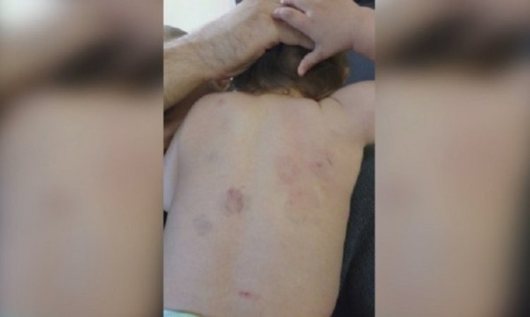 Дете с жестоки ухапвания в ясла. Директорката: Не са били сами!